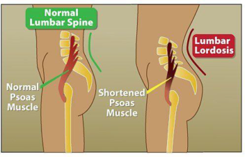 Lumbar spine and Lordosis