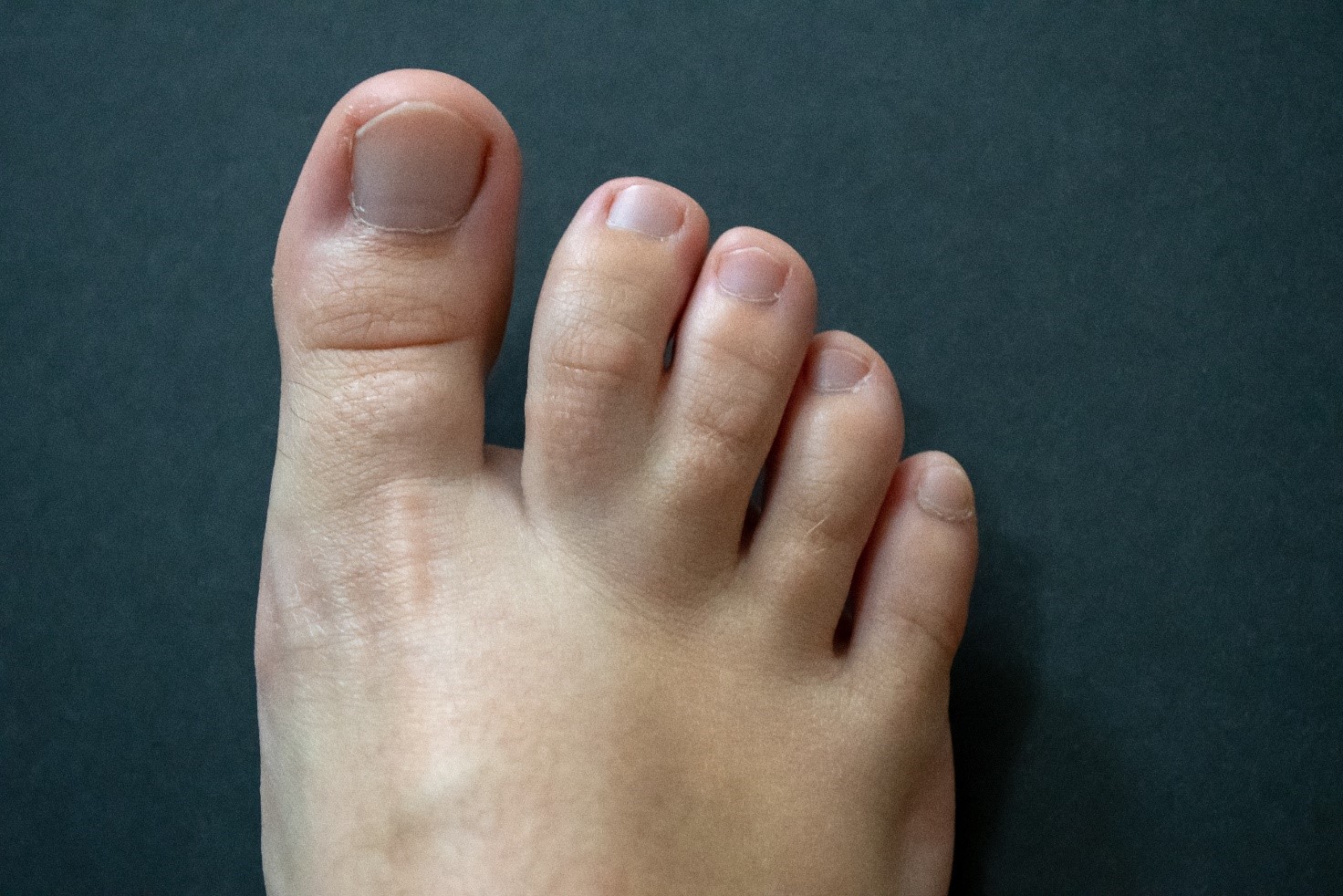 Sindattilia cos'è, cause e trattamenti Studio Alagna